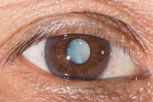 Exercises to improve vision are indicated for cataracts.