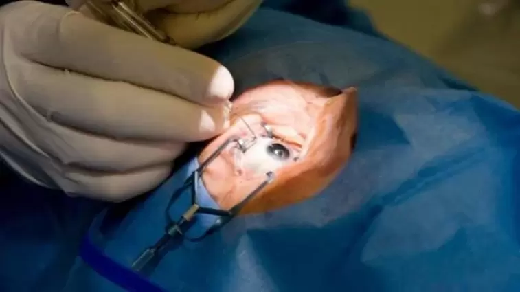 Vitrectomy - removal of the vitreous humor from the eye
